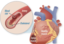 “Hardening of the Arteries” Is Only Half the Story