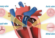 Younger Age Requires Different Aortic Valve Surgery