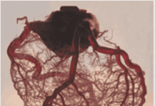 Chest Pain Without Blocked Arteries?  Think INOCA