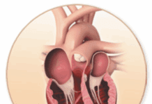 Update on ATTR Amyloidosis